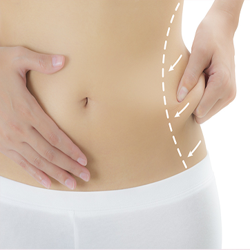 criolipolisis